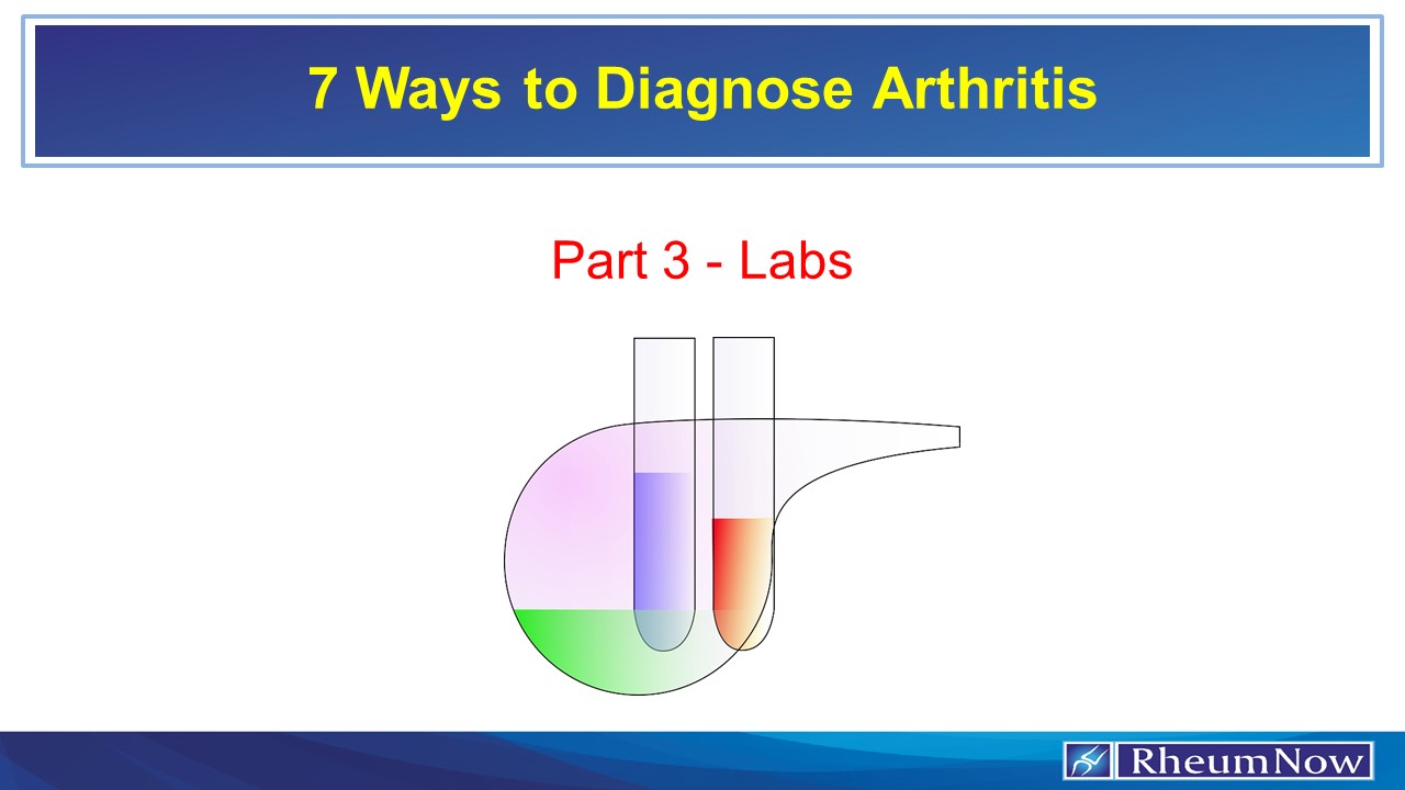 Seven Ways to Diagnose Arthritis Labs RheumNow
